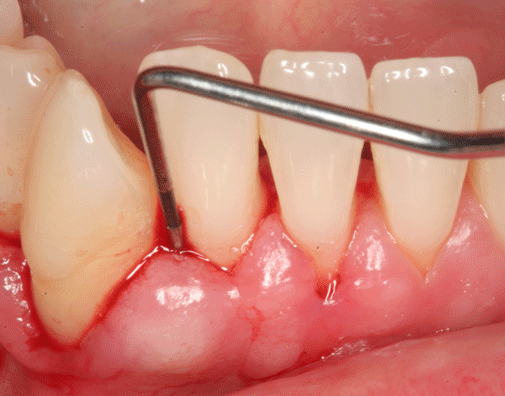 Advanced stage of gum disease Periodontist